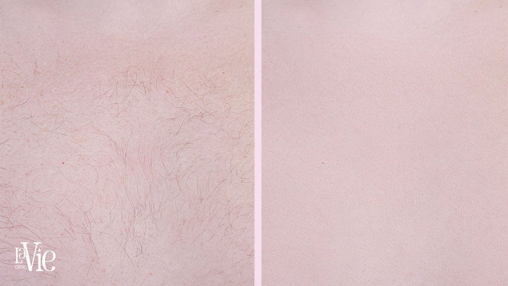 Laser Hair Removal Rochester hills - Before and After results