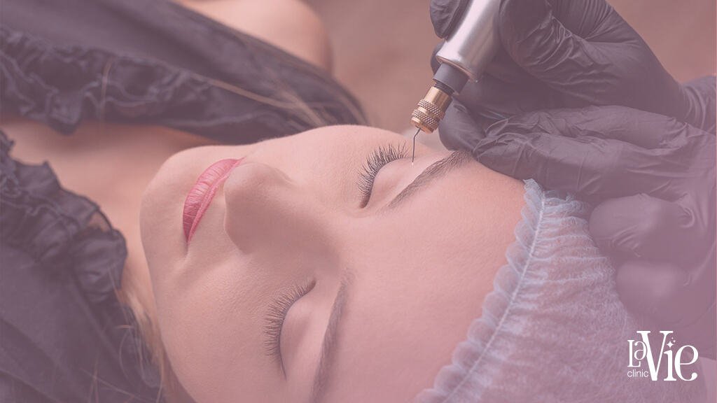 specialist injects Non-Surgical Facelift solution into the jawline to improve skin texture, offer mild-to-moderate skin tightening effects, result in some degree of skin facial contour change,La Vie Clinic Rochester Hills.