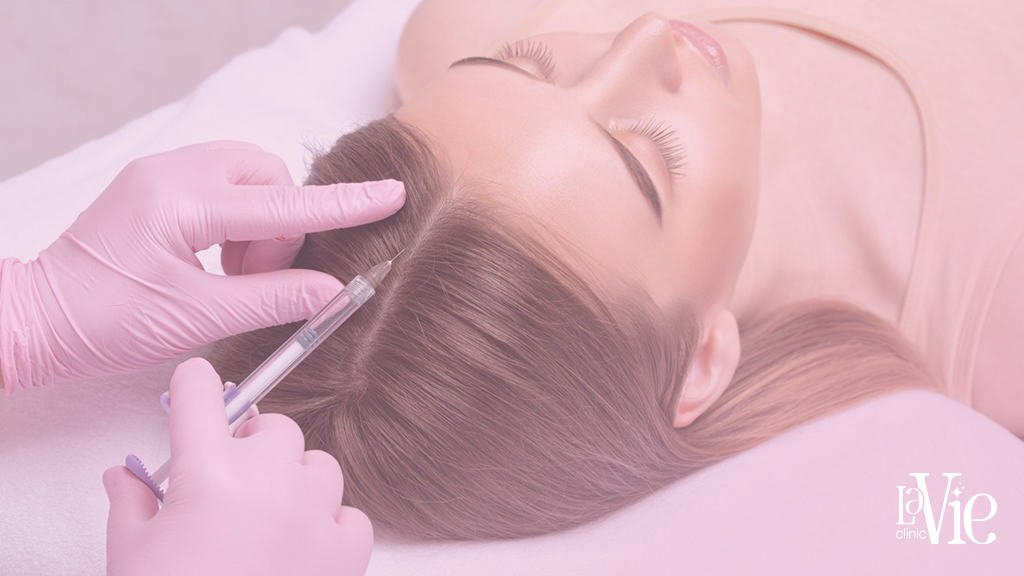 specialist injects platelet-rich fibrin (PRF) solution into the scalp to stimulate hair growth,La Vie Clinic Rochester Hills, while the