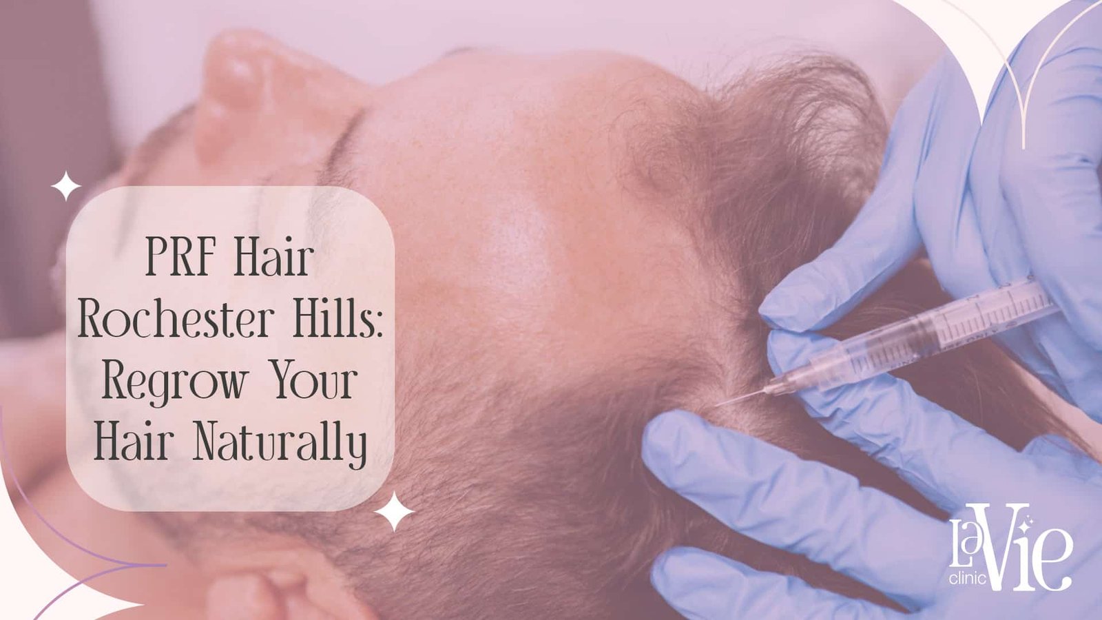 PRF Hair Rochester Hills: A Natural Solution for Thinning Hair.