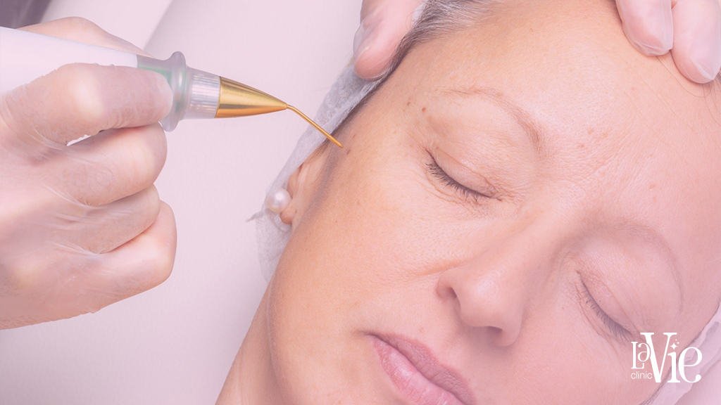 Fibroblast Non Surgical Facelift