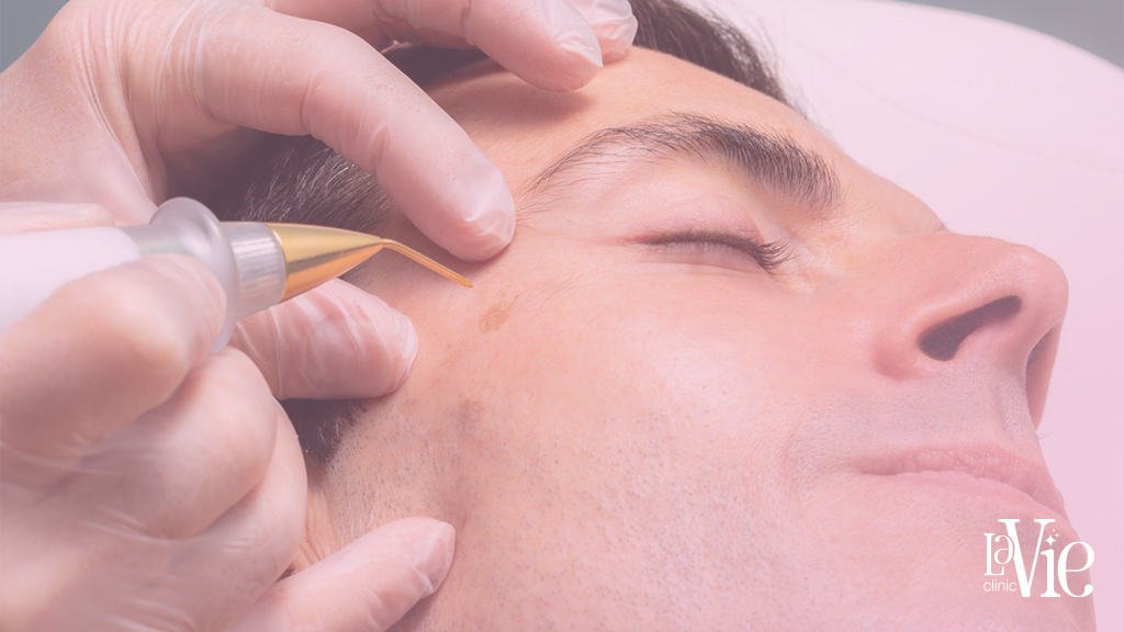Fibroblast Non Surgical Facelift