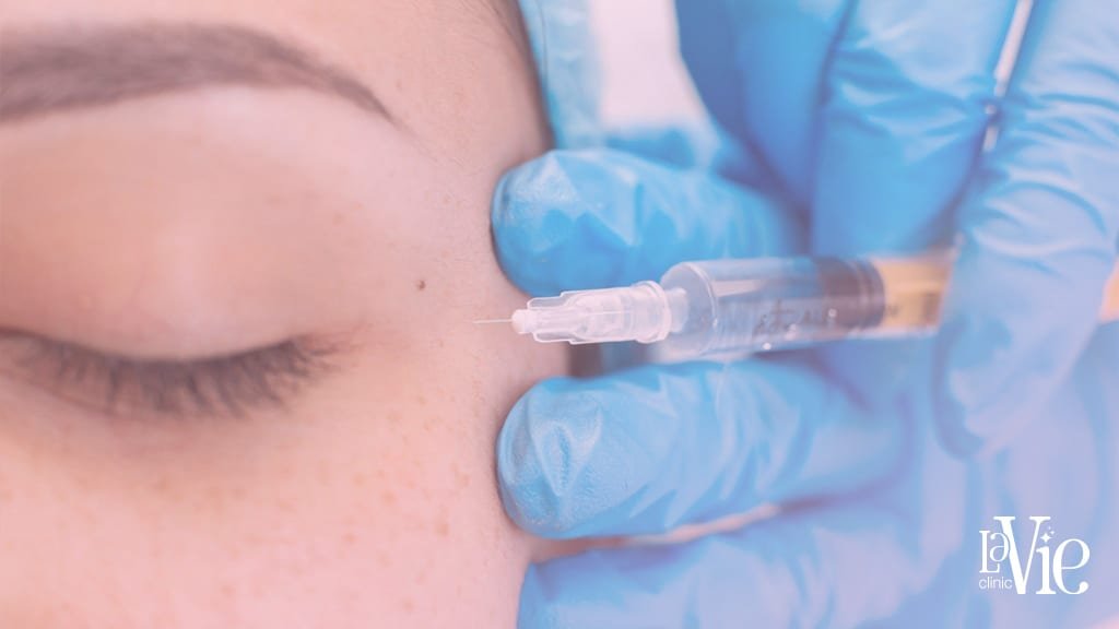 dermal fillers before and after results