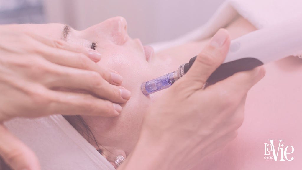 microneedling before and after for Glowing Skin
