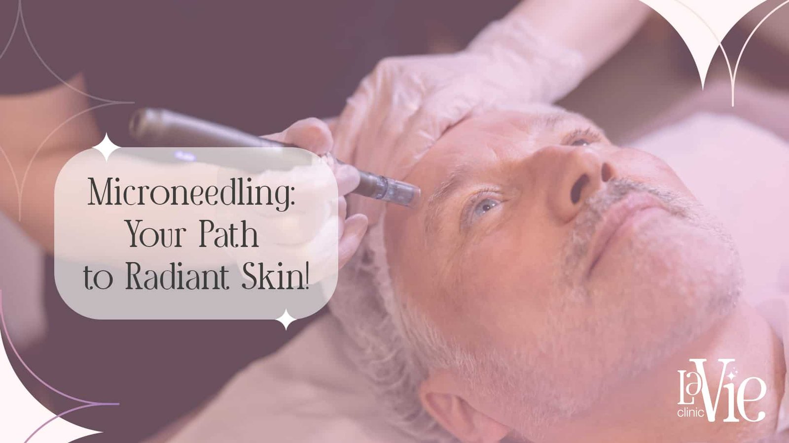Microneedling Before and After: Wrinkle Treatment in No Time!