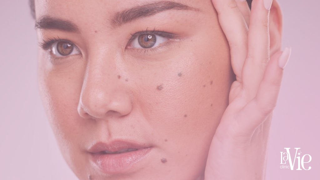 a close-up of a female's face Before Mole Removal treatment