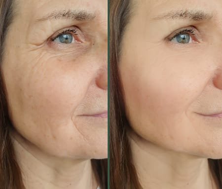 Face microneedling with Exosomes before and after