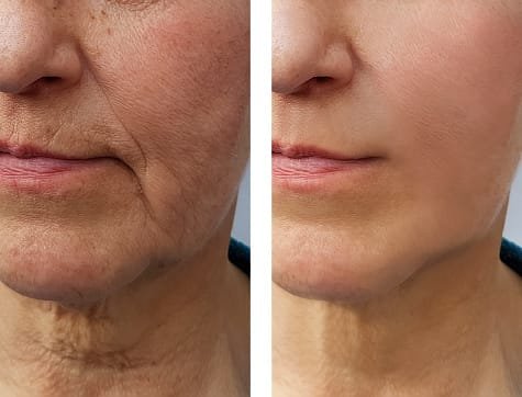 Face and neck microneedling with Moxi laser treatment