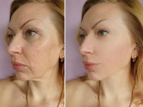 Face microneedling with PRP and vitamin c