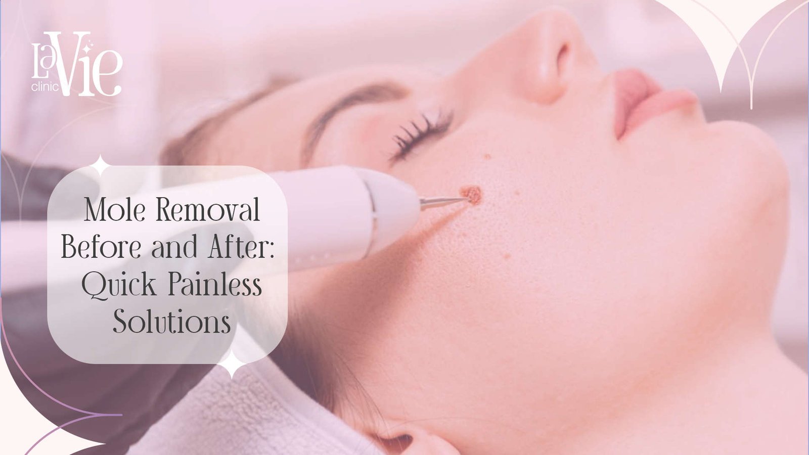 Mole Removal Before and After: Quick Painless Solutions.