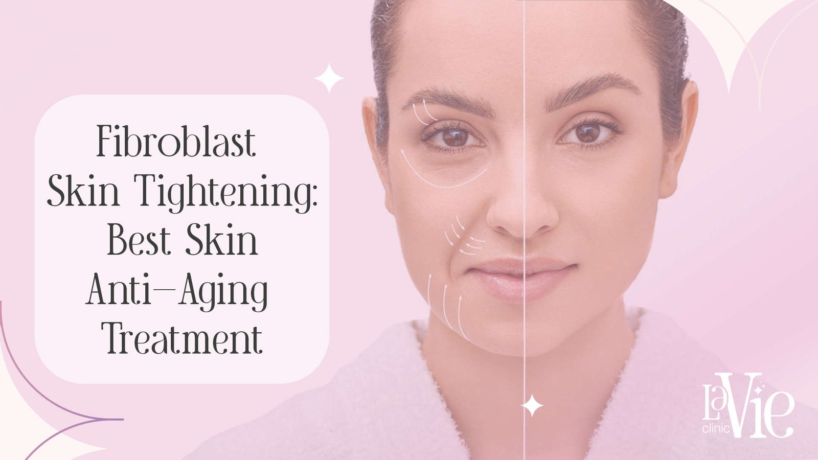 Fibroblast Skin Tightening Rochester Hills Treatment.