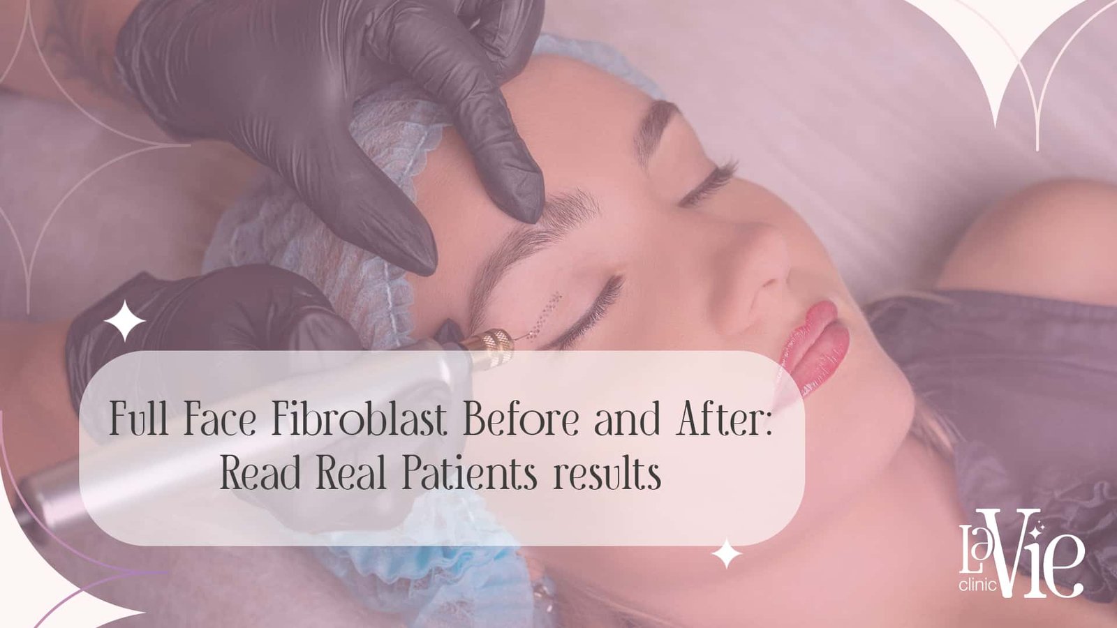 Full Face Fibroblast Before and After: Read Real Patients Results.