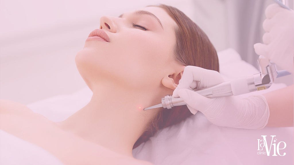 Laser skin tag removal