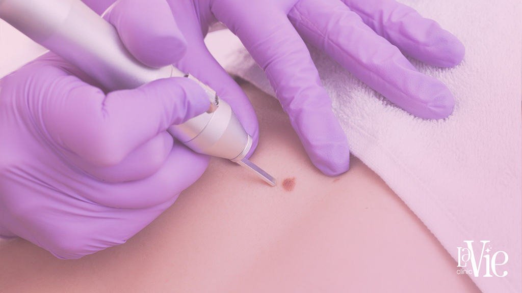Laser skin tag removal