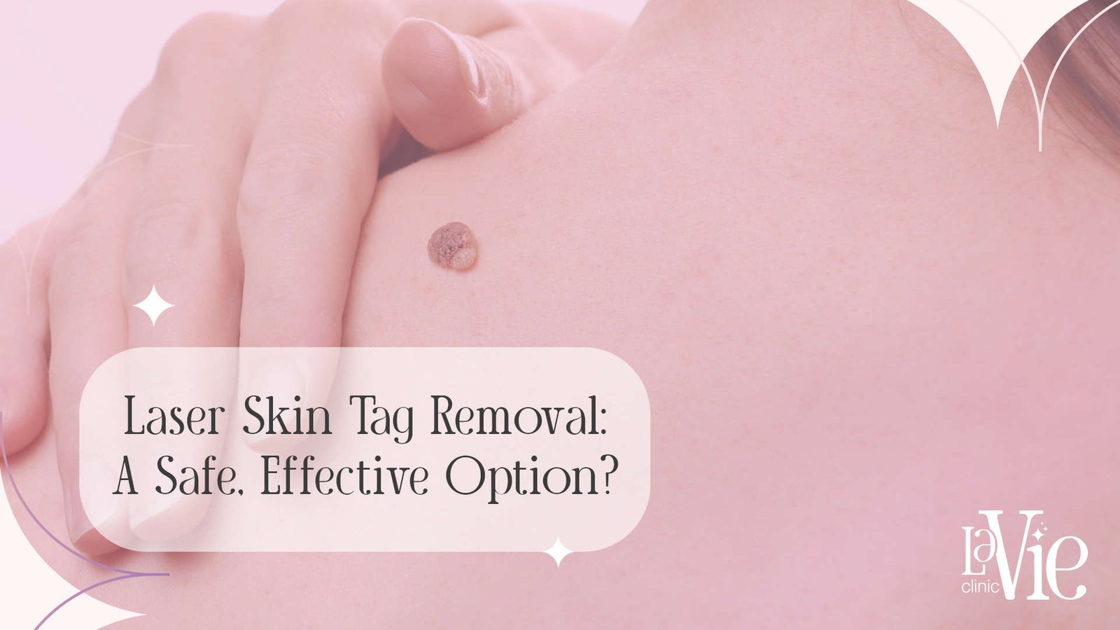 Laser Skin Tag Removal: A Safe, Effective Option?