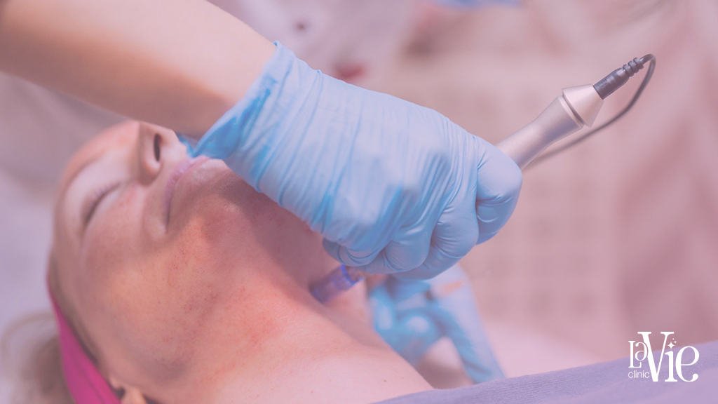 microneedling before and after 1 treatment
