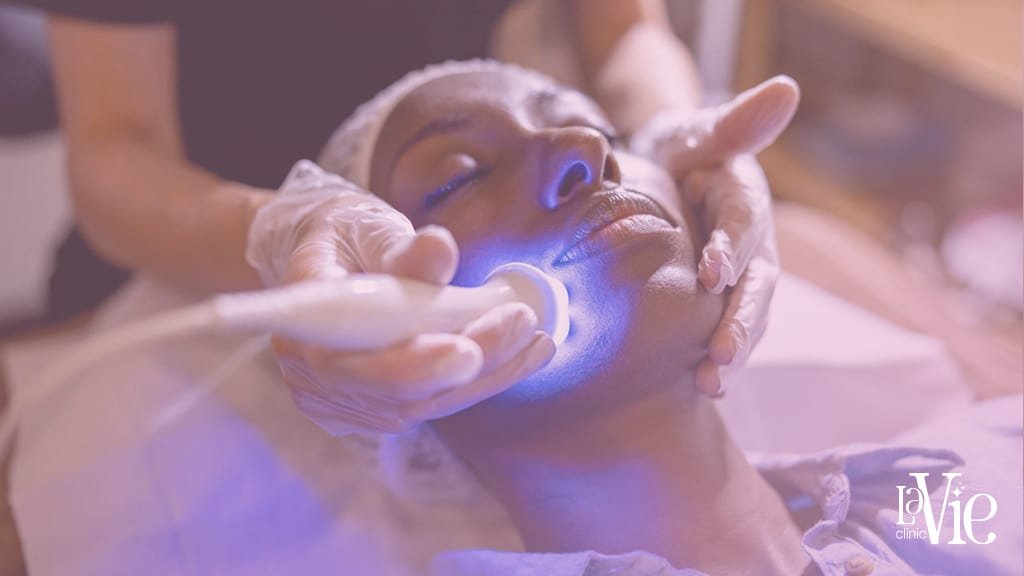 Microneedling Before and After results - La Vie Clinic