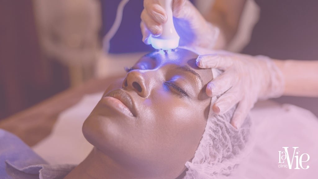 Microneedling Before and After results - La Vie Clinic