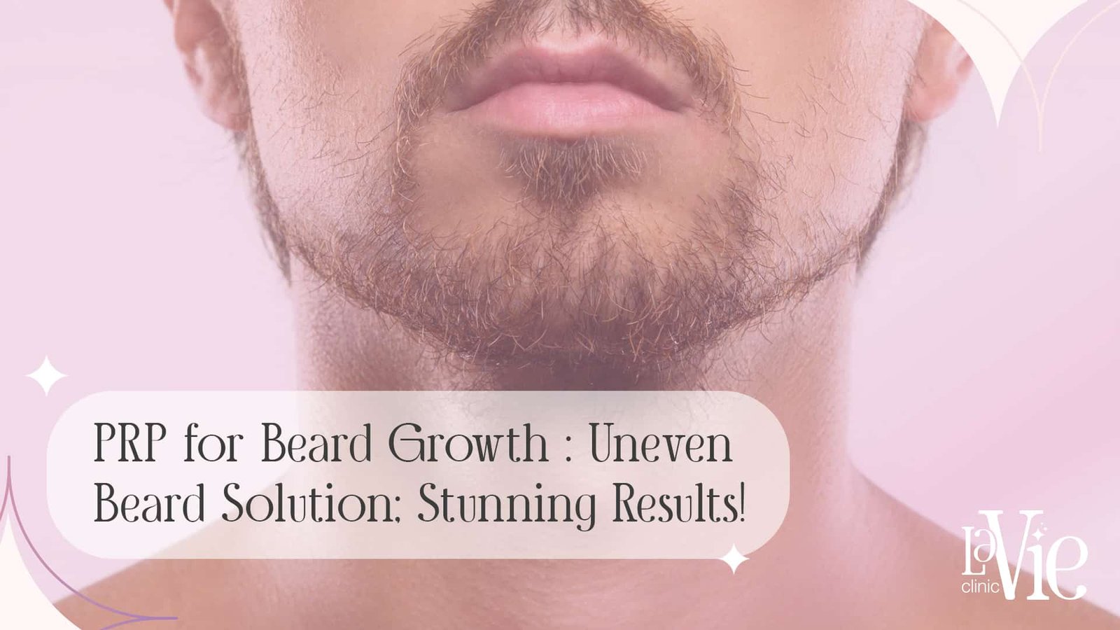 PRP for Beard Growth: Emerging Treatment; Stunning Results!