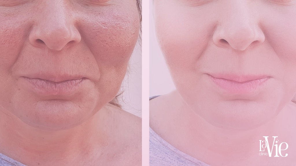 Fibroblasting