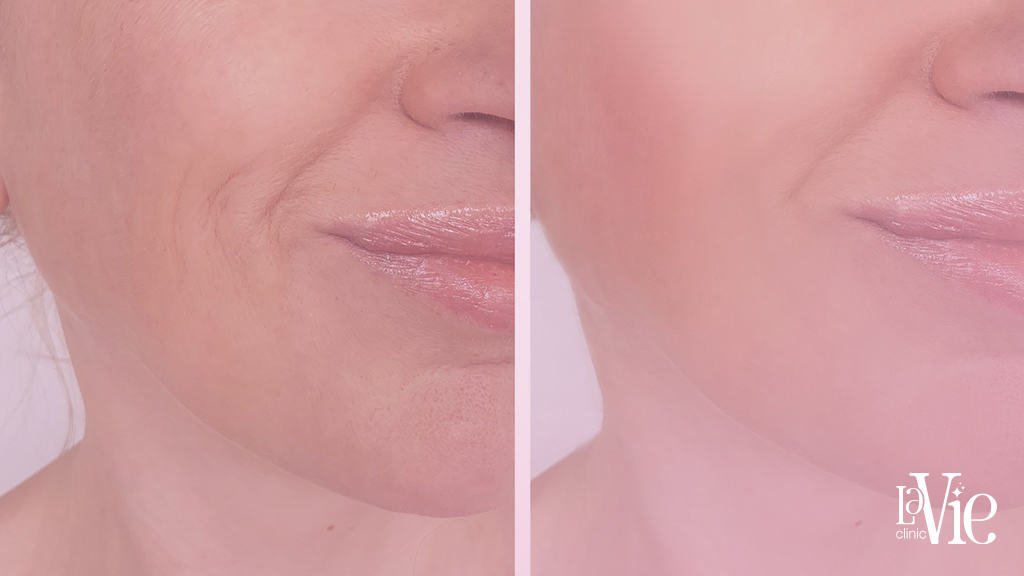 Fibroblasting