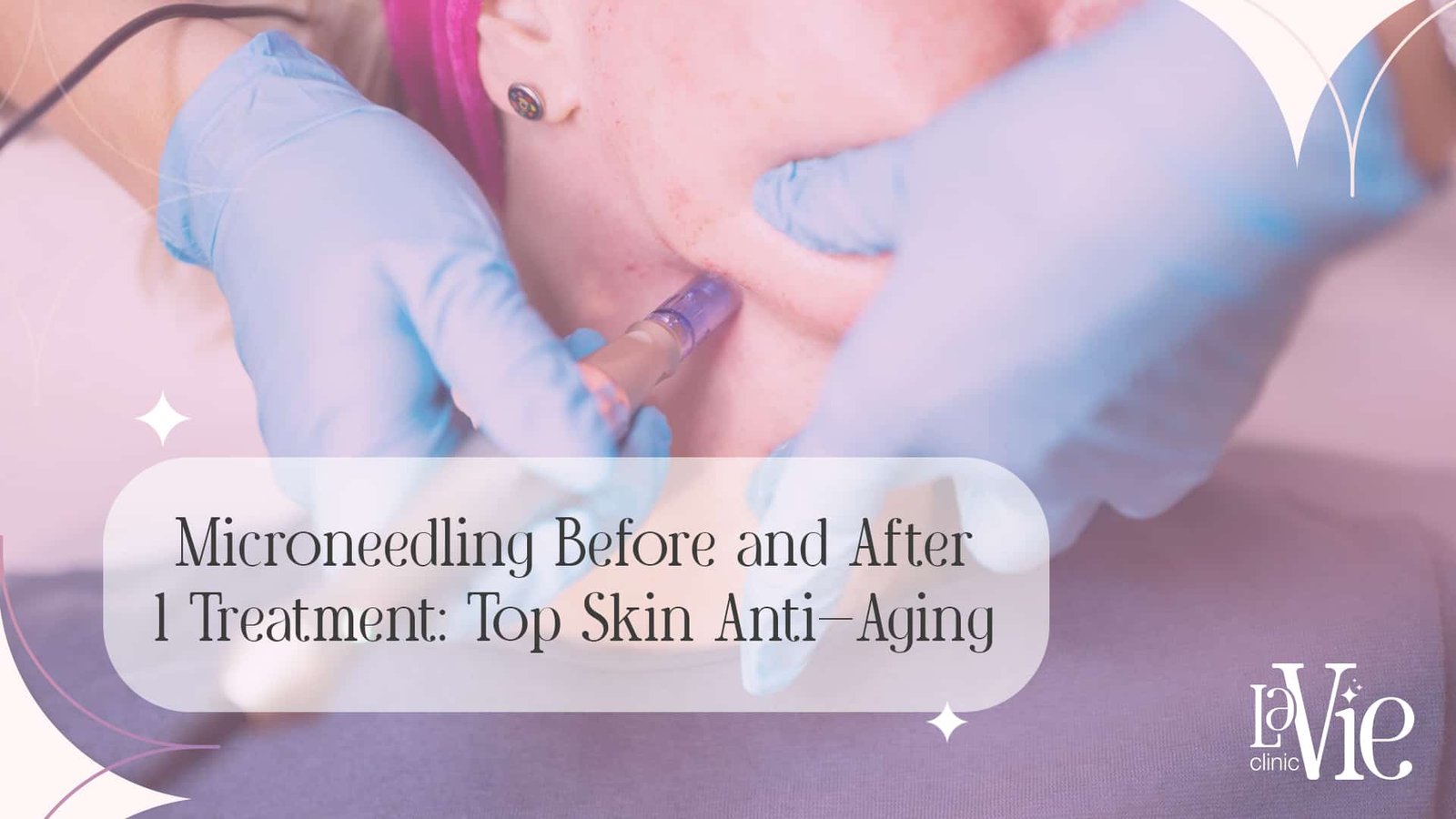 Microneedling Before and After 1 Treatment: Top Skin Anti-Aging.