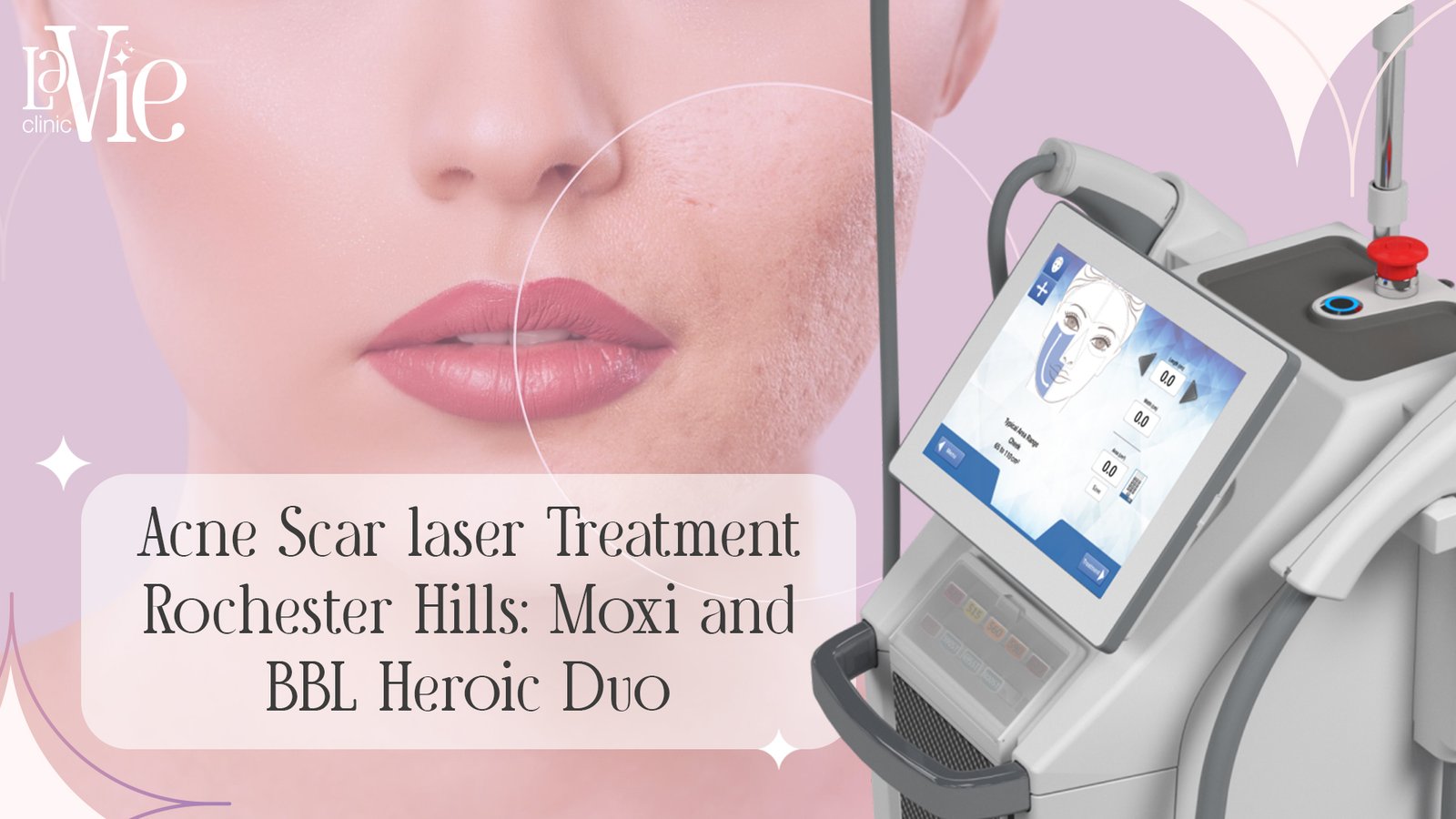 Acne Scar laser Treatment Rochester Hills: Moxi and BBL Heroic Duo