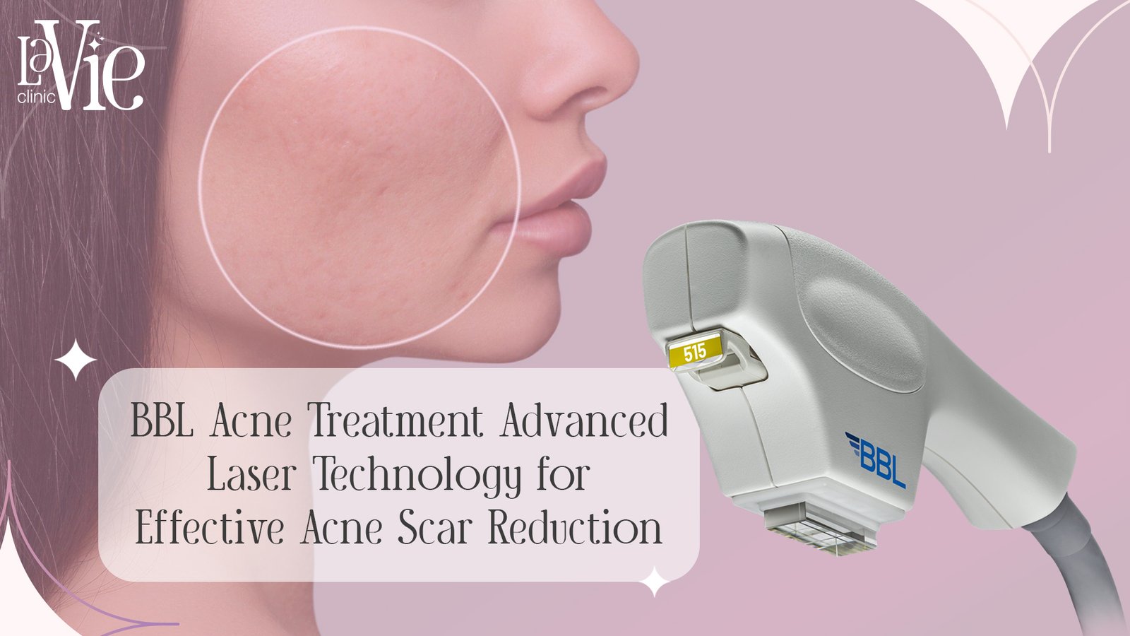 BBL Acne Treatment: Effective Laser Technology for Acne