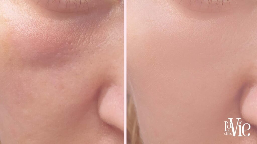 moxi laser before and after
