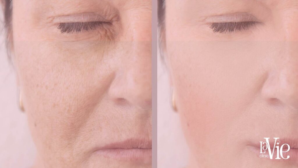 moxi laser before and after