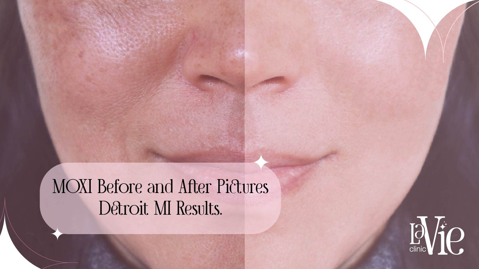 MOXI Laser Before and After Pictures – Detroit MI Results