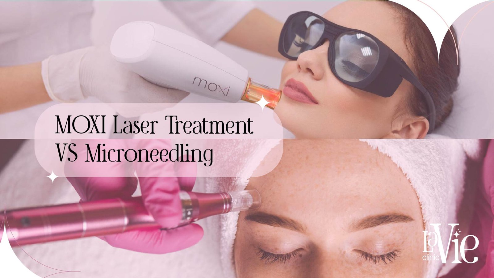 Top 5 Benefits for MOXI Laser Treatment VS Microneedling 