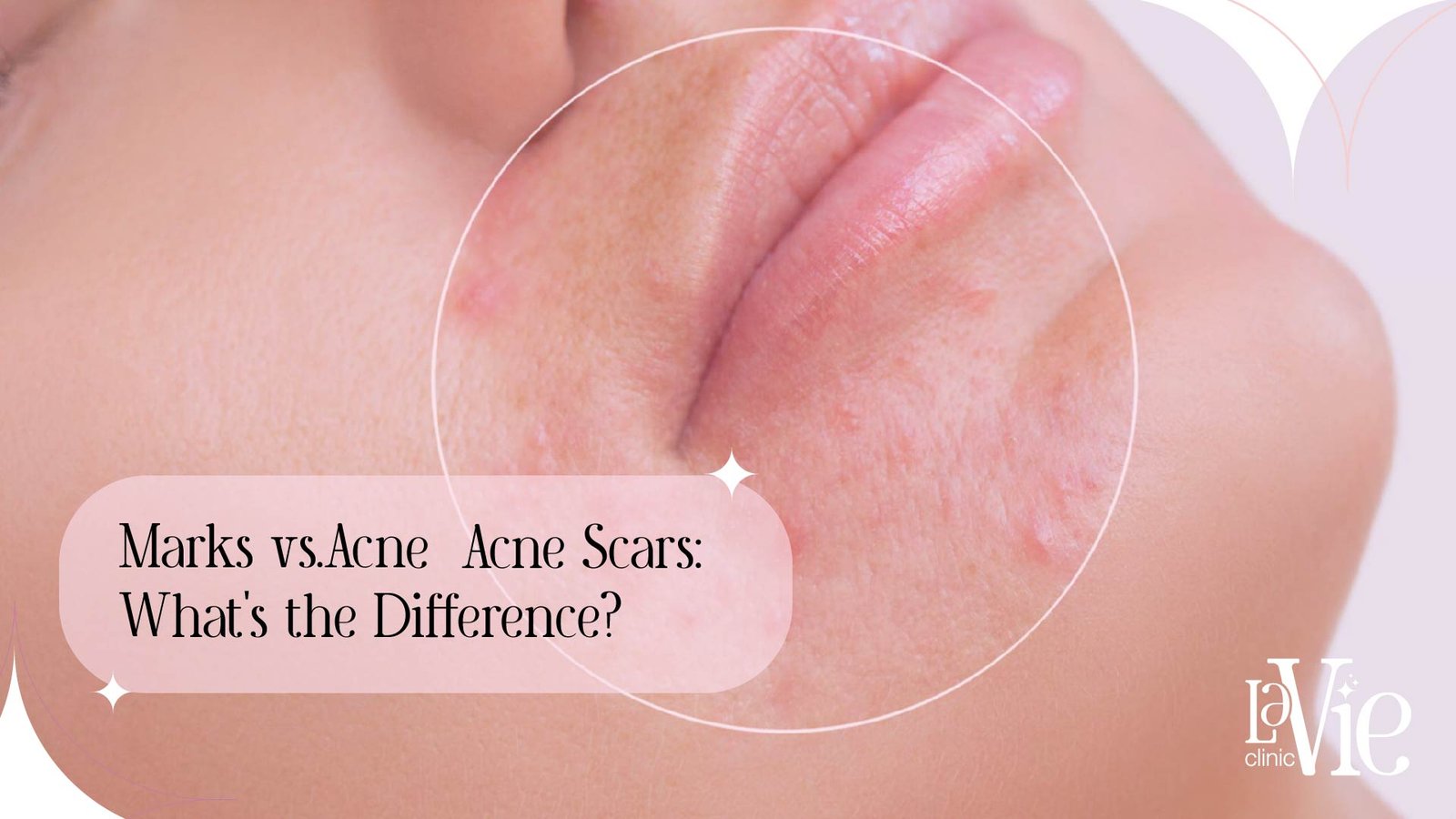 Acne Marks vs Acne Scars: What’s the Difference?