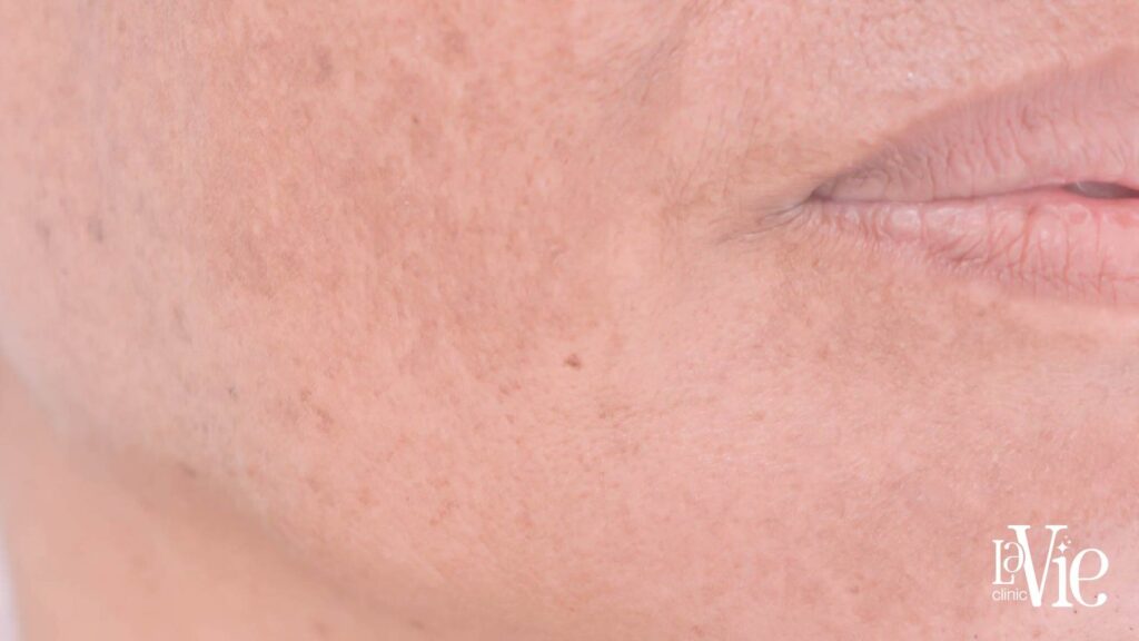 moxi laser before and after