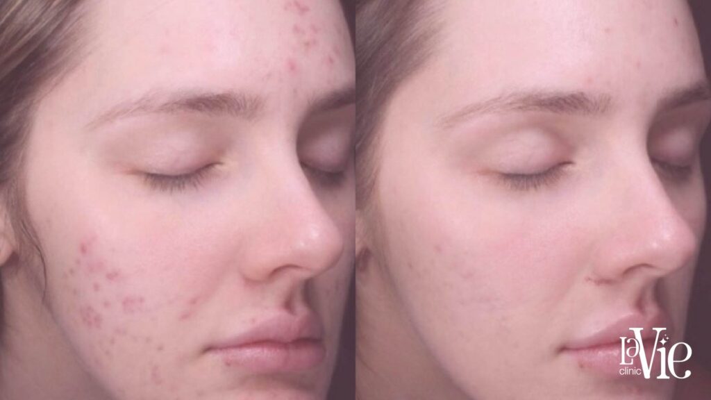 moxi laser before and after