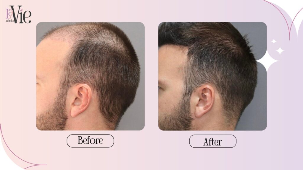 Hair Microneedling & PRP For Hair loss