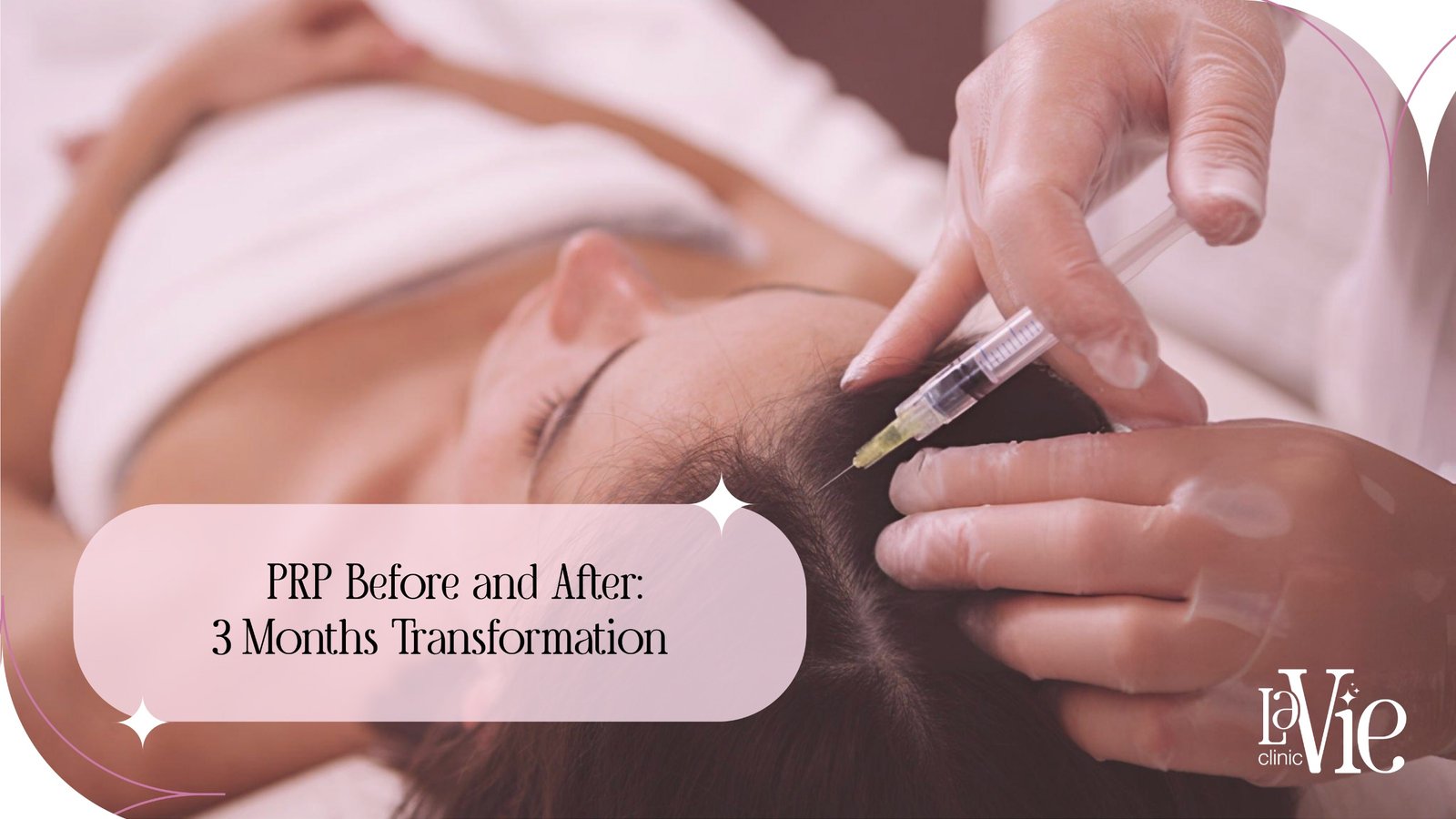 3 month prp for hair loss before and after