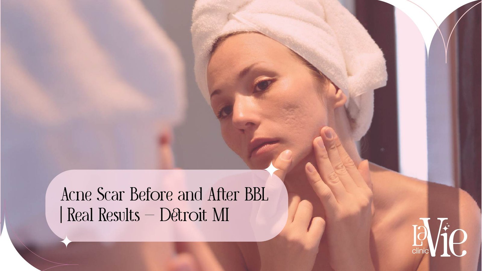 Acne Scars Before and After BBL | Real Results - Detroit MI