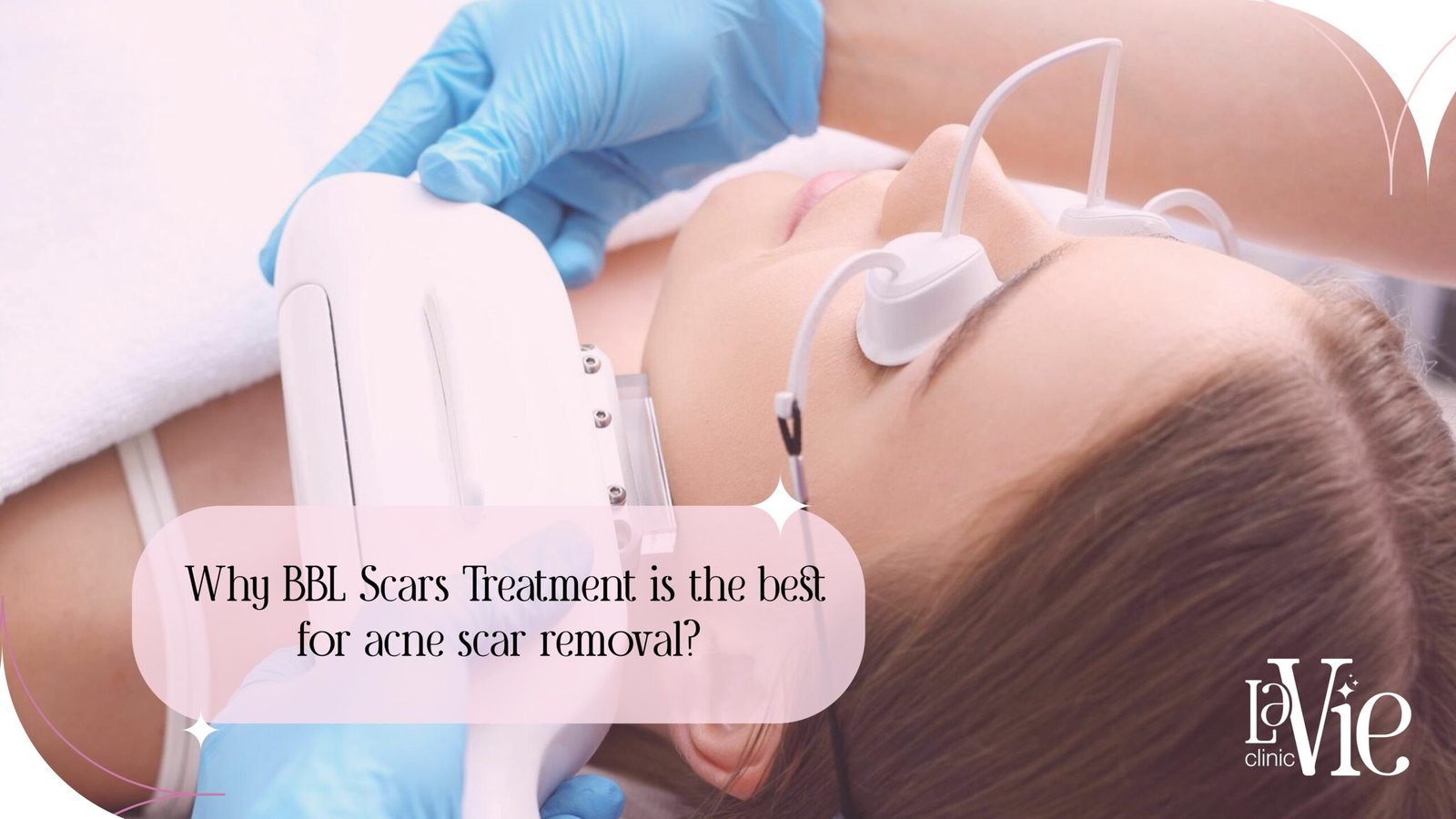 Why is BBL Scars Treatment the Best for Fading Acne Scars?