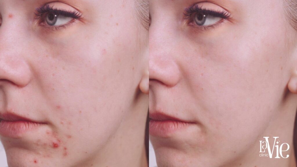 BBL Scars Treatment