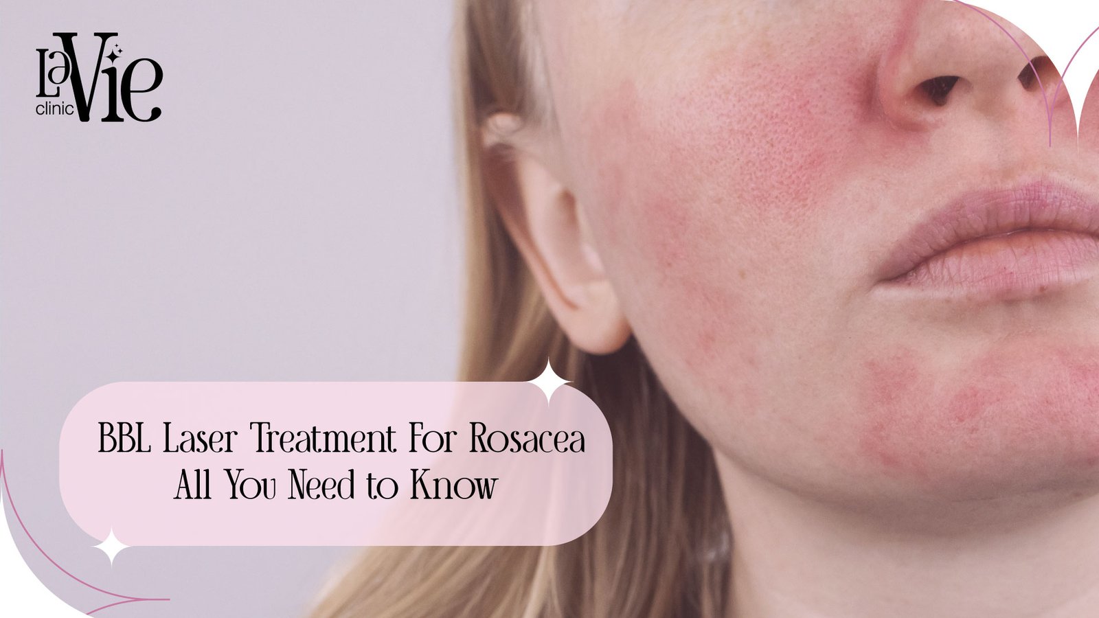 All You Need to Know about BBL Laser Treatment for Rosacea