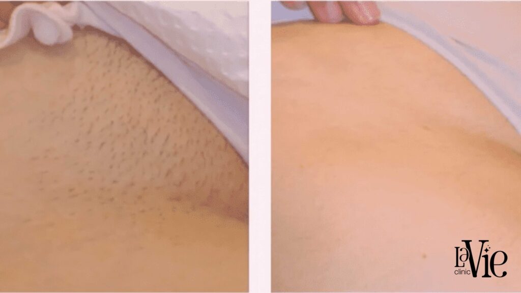 forever bare bbl laser hair removal
