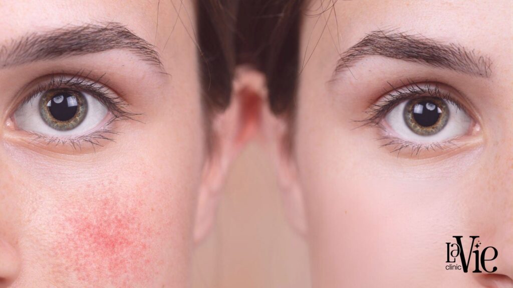bbl laser for rosacea - before and after results