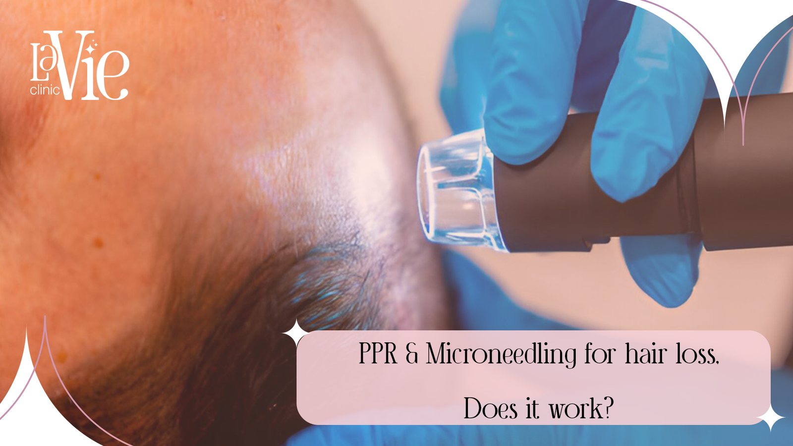 PPR & Microneedling for Hair Loss, Does it Work?