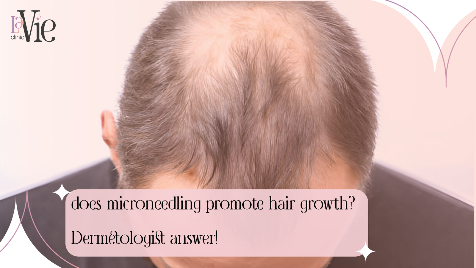 Does Microneedling Promote Hair Growth? Dermatologists Answer!