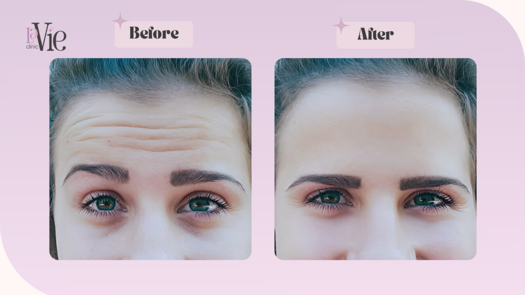 Microtox vs Botox before and after results