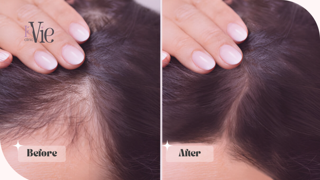 PRF EZ Gel before and after results 