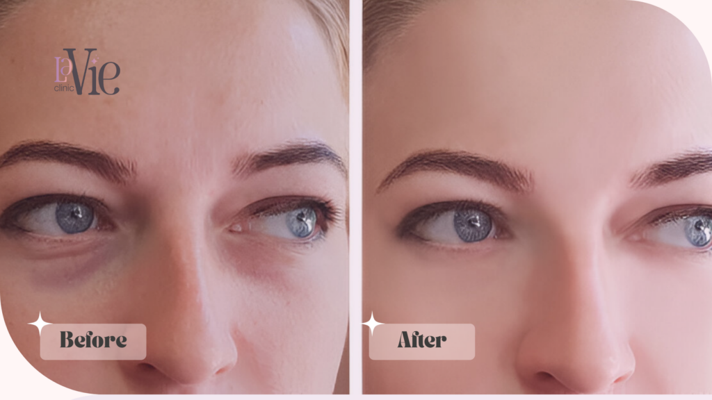 EZ Gel PRF before and after results