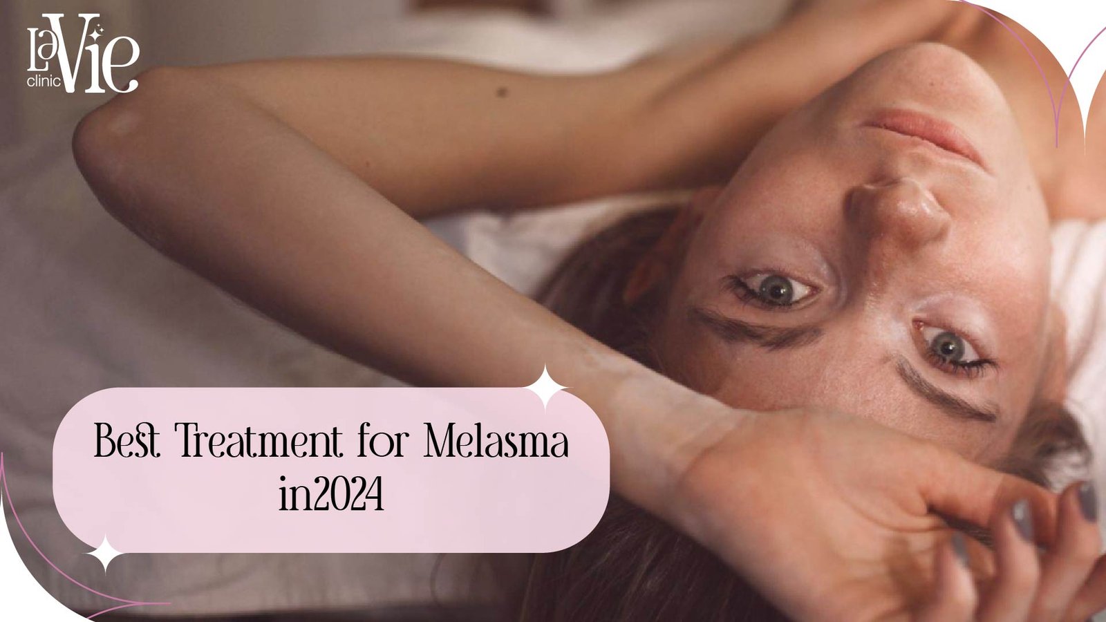 Best Laser for Melasma | Rochester Hills Dermatologists’ Tips