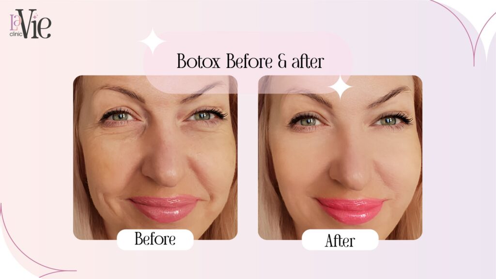 Masseter Botox Before & after GBP